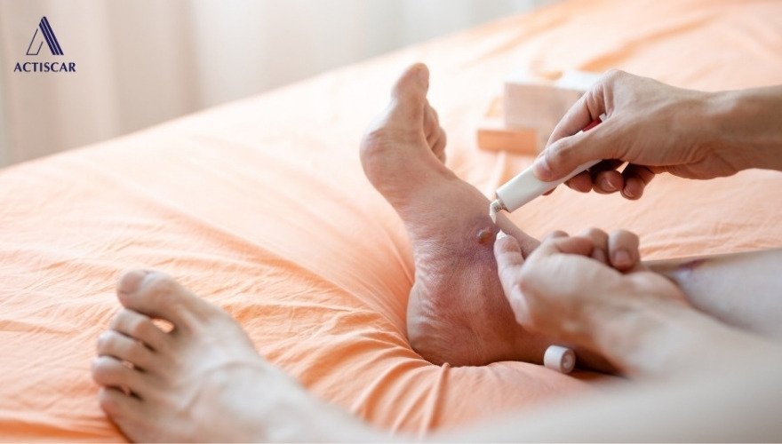 Cách xử lý sẹo lồi ở chân khi sẹo mới hình thành