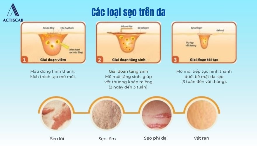 Cơ chế hình thành và các loại sẹo trên da