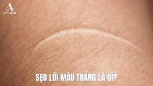 Thế nào là sẹo lồi màu trắng