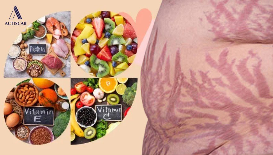 Chế độ dinh dưỡng hỗ trợ cải thiện rạn da