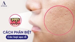 Phân biệt các loại sẹo rỗ